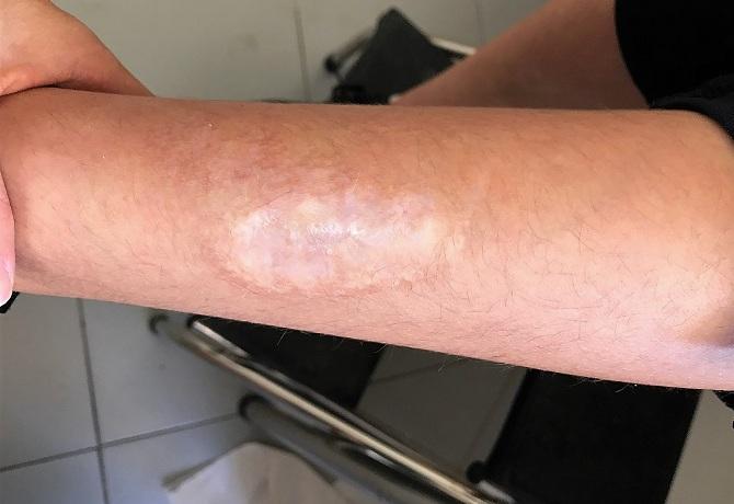 Herida tras la cura de los profesionales de dermatología. 