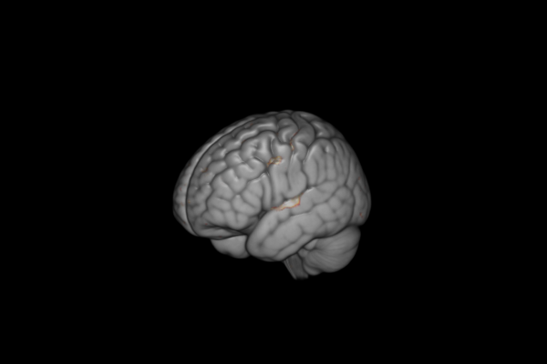 Diferencias encontradas entre afectados y no afectados por el TEA, proyectadas sobre un modelo de cerebro 3D.
