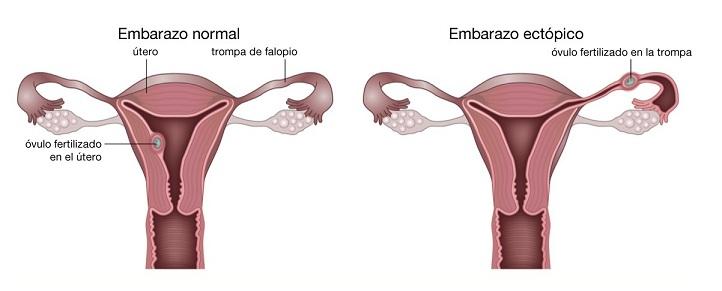 Diferencia entre embarazo normal y ectópico.