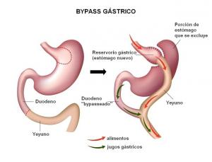 Explicación de en qué consiste un bypass gástrico.