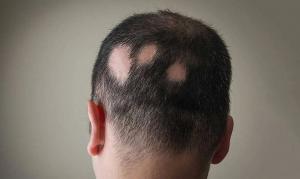 Una persona con alopecia areata. 