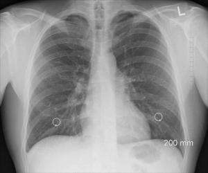 Radiografía de pulmón. 