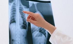 Radiografía de los pulmones. 